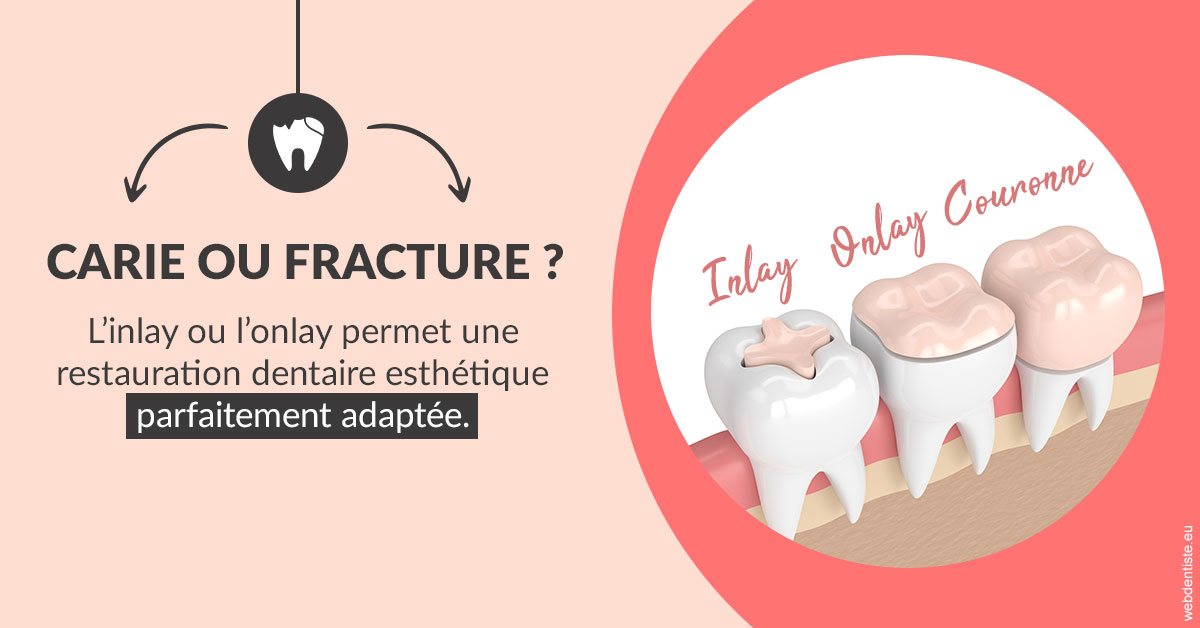 https://dr-prats-cecile.chirurgiens-dentistes.fr/T2 2023 - Carie ou fracture 2