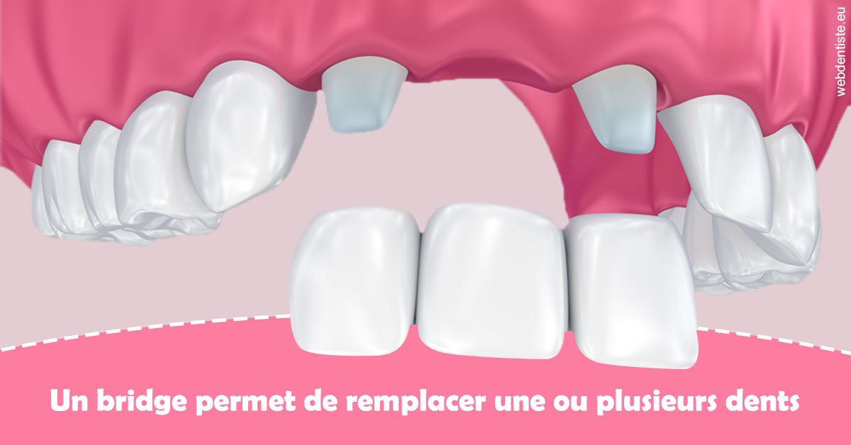 https://dr-prats-cecile.chirurgiens-dentistes.fr/Bridge remplacer dents 2