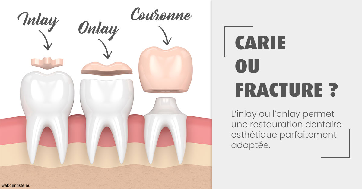 https://dr-prats-cecile.chirurgiens-dentistes.fr/T2 2023 - Carie ou fracture 1