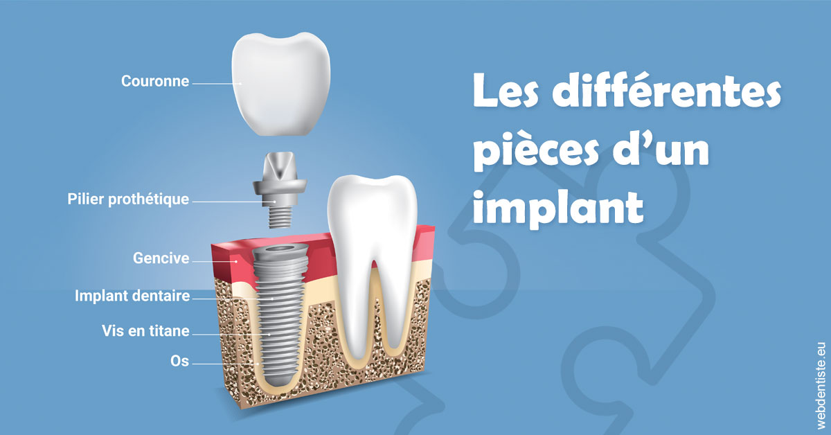 https://dr-prats-cecile.chirurgiens-dentistes.fr/Les différentes pièces d’un implant 1