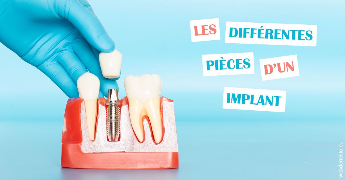 https://dr-prats-cecile.chirurgiens-dentistes.fr/Les différentes pièces d’un implant 2
