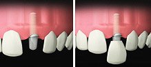 implant_quest_ce_que_implant_dentaire